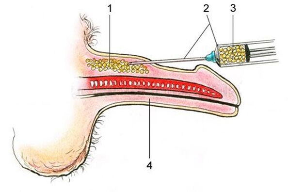 Lipofilling - zavedení tukové tkáně do dříku penisu