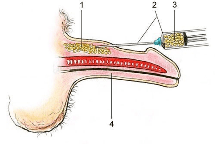 Lipofilizace pro zvýšení člena