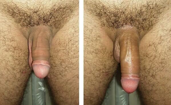Penis před a po ligamentotomii a lipofillingu