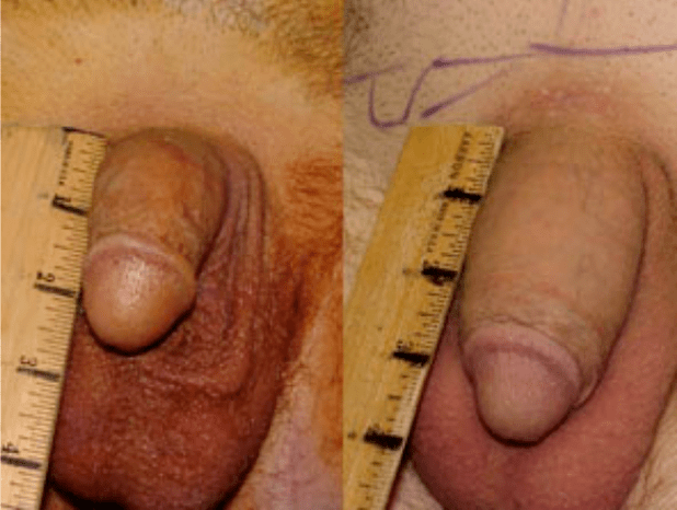 Před a po lipofillingu a implantaci gelu